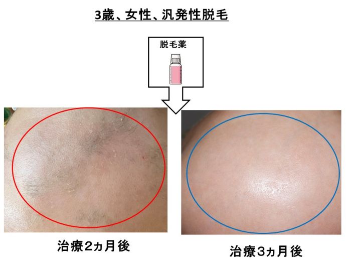 円形脱毛症　病院